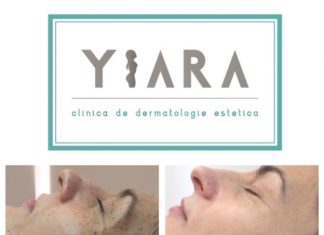 Cum scapi de aluniţe cu procedura de eliminare aluniţe laser Cum scapi de alunite cu procedura de eliminare alunite laser