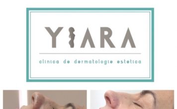 Cum scapi de alunite cu procedura de eliminare alunite laser
