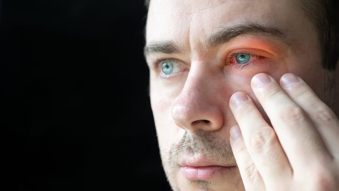 3 tipuri de conjunctivită și tot ce trebuie să știi despre ele