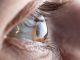 Cum recunoști astigmatismul și cum se corectează