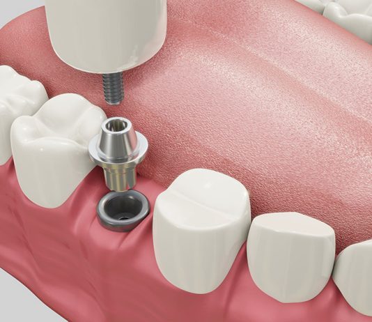 Implantul dentar: argumente pro și contra